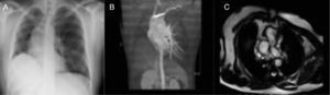 A) Radiografía de tórax en la se aprecia elevación del hemidiafragma derecho. B) Reconstrucción del TAC donde se observa la ausencia de la arteria pulmonar derecha. C) Corte de cardiorresonancia magnética con agenesia de la arteria pulmonar derecha y agenesia parcial del pulmón derecho.