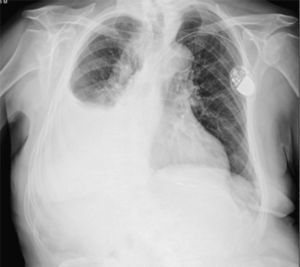 Radiografía posteroanterior de tórax. Extenso derrame pleural derecho. Marcapasos endocavitario.