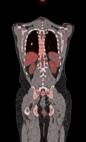 18F-FDG PET/CT scan. Highly metabolic nodule of the right lower lobe, without mediastinal lymphadenopathy.