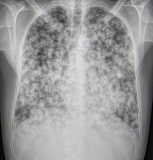 Rx de tórax: nódulos pulmonares bilaterales, la mayoría cavitados.