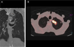 A) TC coronal con ventana de pulmón: masa cavitada con pared gruesa irregular de 18 mm en lóbulo superior izquierdo que se continúa hacia el mediastino. B) PET-TC axial: la masa muestra alta captación de fluorodesoxiglucosa, con un valor estándar de captación (standard uptake value) de 28,38 unidades.