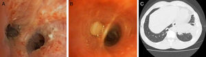 A) Broncoscopia: carinas bronquiales con engrosamientos irregulares y mucosa con lesiones de aspecto granular, sobreelevadas, de fondo blanquecino con punteado eritematoso. B) Broncoscopia: imagen endoscópica del segmento 8 izquierdo con material blanquecino denso que obstruye la luz bronquial totalmente. C) Tomografía axial computarizada: infiltrado de aspecto alveolar con broncograma aéreo, localizado en lóbulo inferior izquierdo.