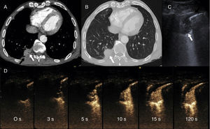 A y B) TC de tórax tras la administración de contraste yodado intravenoso en ventanas mediastino (A) y de pulmón (B) en el que se visualiza nódulo sólido subpleural (flecha blanca) con engrosamiento pleural adyacente (flecha negra) e incurvación broncovascular (flecha gris). C) Ecografía torácica en modo B: consolidación redondeada (flecha blanca) asociada a un engrosamiento pleural focal (flecha negra). D) Serie de imágenes de la ecografía torácica con contraste (aparece en cada imagen el tiempo transcurrido desde la administración del mismo) en el que se pone de manifiesto una rápida captación del mismo, antes de los 6s, que inmediatamente se convierte en homogénea y no muestra lavado tras más de un minuto de exploración.