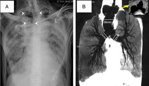 A) Chest X-ray at admission shows bilateral opacities and easily overlooked enlarged trachea (white arrow). B) Coronary computed tomography (CT) image showing diverticulums at proximal trachea. Diameters of distal trachea, right and left main bronchus were 36mm, 24mm, and 22mm respectively.