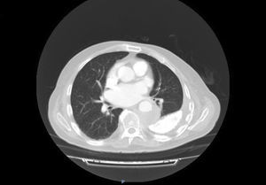 Corte TC de tórax a nivel de la lesión. Se observa imagen de consolidación pulmonar paraaórtica adyacente. A calcificación pleural posterior izquierda.