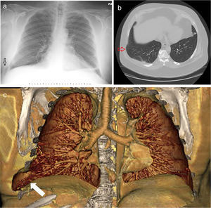 (a) Chest X-ray showing lateral lung herniation (arrow). (b) Axial view of Chest CT in lung window showing lung herniation (arrow). (c) Coronal 3D volume rendered colored image demonstrating widening of the right 8th–9th lateral intercostal rib space with herniation of right lung parenchyma (white arrow).