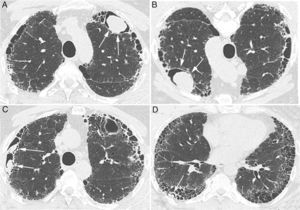 Chest CT images showing peripheral cysts pattern with honeycomb at the lung bases with an intracavitary nodule positioned anteriorly in the upper left lobe (A) that shifts position when the patient