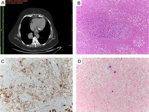 Granulomatosis linfomatoide. A) Nódulo pulmonar único derecho y micronódulos en lóbulo superior derecho y hemitórax izquierdo (TAC de tórax). B) Células mononucleares de talla grande con el patrón angiocéntrico característico y abundante necrosis tumoral (H&E, ×10). C) Linfocitos de talla grande de estirpe B alrededor de vasos sanguíneos (CD20, ×20). D) Positividad en las células B grandes para la hibridación in situ del VEB (EBER, ×40).