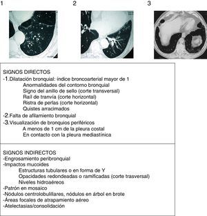 Signos radiológicos de bronquiectasias (imágenes encima de la tabla de los 3 criterios principales o signos directos de Naidich et al.) Fuente: Webb et al.16.