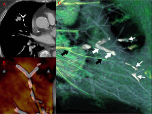 Tomografía computarizada dual tras la administración de contraste yodado intravenoso. A) Imagen axial en la que se evidencia una imagen lineal ramificada de alta densidad en una arteria subsegmentaria en el segmento medial del lóbulo medio (flecha gris) sugestiva de émbolo de cemento. B) Mapa de perfusión con yodo que permite identificar áreas de hipoperfusión (estrellas grises) distales a la lesión lineal densa descrita previamente. C) Mapa vascular que permite visualizar los vasos con yodo en su interior de color verde (flechas negras) y los defectos de repleción atribuibles al cemento se identifican de color blanco (flechas blancas gruesas). Noten como este tipo de reconstrucción permite identificar un mayor número de defectos en vaso de menor calibre (flechas blancas delgadas).