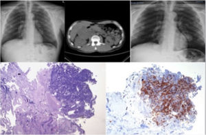 A. Radiografía de tórax en decúbito que muestra amplias áreas de condensación bilateral. B. Tomografía computarizada de tórax que evidencia extensas condensaciones pulmonares con broncograma aéreo en su interior. C. Muestra de biopsia bronquial: se observan células escamosas con núcleos agrandados, en ocasiones múltiples, con cromatina borrosa «en vidrio deslustrado», característica típica de infección por virus herpes (H.E. 400x).