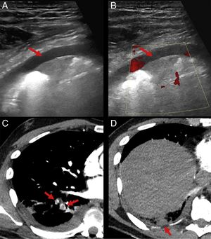 Ecografía y TAC torácico con defecto de repleción en arterias segmentarias del LID y consolidación subpleural de morfología triangular con base pleural, diagnóstico de TEP con infarto pulmonar.