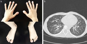 a) Acropaquias en dedos de manos y pies. b) TC pulmonar de control con progresión del patrón en vidrio deslustrado y aparición de nuevas lesiones quísticas.