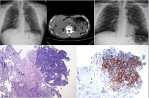 En la parte superior izquierda se encuentra la radiografía de tórax del paciente; en el centro aparece una imagen de la TAC en la que se aprecia la masa suprarrenal y a la derecha una radiografía de tórax en la que se observa la rápida progresión de la lesión pulmonar. En la parte inferior de la figura se encuentran las imágenes anatomopatológicas del carcinoma suprarrenal inhibina positiva y CK7, TTF-1 y napsina negativa.