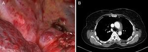 (A) Videothoracoscopic image of the aneurysm of the Azygos vein. (B) Axial contrast-enhanced CT scan. Postoperative review of the images confirmed the presence of a saccular aneurysm (white arrow) in the proximal end of the arch of the azygos vein.