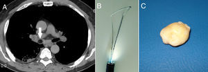 (A) Computed tomography showing the endobronchial lipoma blocking the right main bronchus (white arrow). (B) Our snare mounted in the flexible bronchoscope. (C) 15-mm lobulated soft tissue mass of almost excised lipoma.