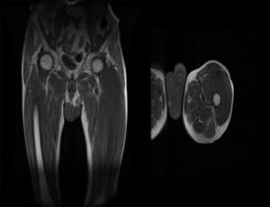 A la derecha se observa un corte sagital de la RMN musculoesquelética y a la izquierda un corte coronal, donde se aprecia la extensión de la afectación tumoral a este nivel.