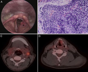 Indirect laryngoscopy (A) shows submucosal bulging mass (asterisk) over the left false cord. Photomicrograph (H&E, ×400) (B) shows small cells with hyperchromatic nuclei and scant cytoplasm. Nuclear moulding and crush artefact are present. PET/CT (C, D) showed increased 18F-FDG uptake in the left supraglottis (SUVmax=2.3) and left neck lymph nodes (SUVmax=4.0).
