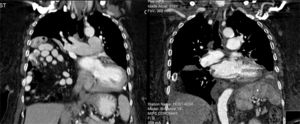 Computer tomography scan before and immediately after surgery showing the right lung expansion (at the right).