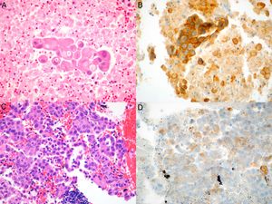 Imágenes microscópicas del tumor en muestras obtenidas por EBUS-TBNA y de las respectivas tinciones inmunohistoquímicas con anticuerpo anti-PD-L1 E1L3N. A) Adenocarcinoma (hematoxilina-eosina, 40×). B) Tinción de membrana >50% de las células neoplásicas (PD-L1 E1L3N XP Rabbit mAb, 40×). C) Adenocarcinoma (hematoxilina-eosina, 40×). D) Tinción de membrana >1% de las células neoplásicas (PD-L1 E1L3N XP Rabbit mAb, 40×).