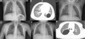 A) Radiografía de tórax PA: quiste aéreo unilocular en la base pulmonar izquierda. B) TC torácica: cavidad aérea de paredes finas en el lóbulo inferior izquierdo. C) Radiografía de tórax PA: aumento de densidad en lóbulo pulmonar superior derecho. No se aprecia ninguna lesión quística. D) Radiografía de tórax PA: quiste aéreo unilocular en el pulmón derecho. E) Radiografía de tórax PA: aumento de densidad en el pulmón derecho. F) TC torácica: imagen quística unilocular con contenido aéreo y pared fina, localizada en el segmento apical del lóbulo inferior derecho.