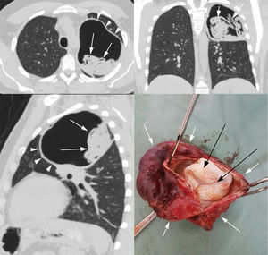 Chest computed tomography with axial (A), coronal (B) and sagittal (C) reconstructions showing a voluminous cavitary lesion (arrowheads) in the left upper lobe containing irregular, serpiginous intracavitary material compatible with free-floating membranes (arrows) of a hydatid cyst (serpent sign). In (D), a photograph of the surgically resected hydatid cyst, showing the outer membrane (pericyst – white arrows) and the inner free-floating membrane (endocyst – black arrows).