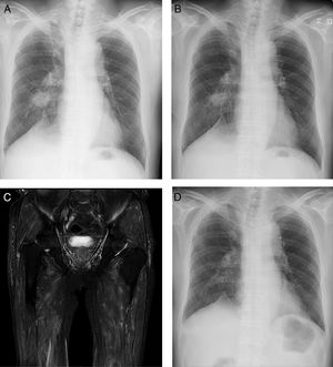 Chest X-ray images at a routine follow up (A) and 5 days after initial pembrolizumab administration (B). Short-tau inversion-recovery magnetic resonance image of the femur (C). Chest X-ray Image 2 months after initial pembrolizumab administration (D).