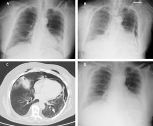(A) Chest radiography 2h following the cryobiopsy showing a marginal left pneumothorax. (B) Chest radiography 4h after the procedure revealing bilateral pneumothorax, pneumomediastinum and subcutaneous emphysema. (C) Computed tomography scan revealing an enlarged area along the lateral basal segmental bronchus (arrow) suspicious of a bronchial laceration. (D) Chest radiography five days after the cryobiopsy showing resolution of the complications.