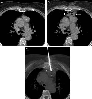 A) Imagen axial de la TC de tórax en la que se observa una masa en mediastino anterior (asterisco). La línea blanca señala el trayecto teórico de la aguja de biopsia desde la pared torácica anterior hasta la masa mediastínica, atravesando la superficie pleural y el parénquima pulmonar izquierdo. B) Imagen axial de la TC de tórax en la que visualiza la creación de una pequeña colección de líquido (flechas) entre la pared torácica anterior y la masa mediastínica. C) Imagen axial de proyección de máxima intensidad de la TC de tórax en la que se observa la aguja de biopsia atravesando la colección de líquido (L) y alcanzando la masa mediastínica (M).