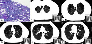 Imágenes de la biopsia renal (A) y de la TC pulmonar (B-F). En A se muestran 2 glomérulos con proliferación extracapilar o semilunas (ácido peryódico de Schiff). B, C, D, E y F son diferentes cortes de la TC pulmonar en los que se aprecia un enfisema mixto centrilobulillar bilateral, con zonas de afectación paraseptal y bullas subpleurales de predominio en lóbulos superiores. En F se puede observar uno de los nódulos de 3,1mm (línea discontinua).