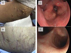 A y B. Tofos gotosos en la articulación del codo y en la pared abdominal. C. Broncoscopia: parálisis de cuerdas vocales en aducción con depósito tofáceo sobre aritenoides. D. Broncoscopia: depósitos de gota tofácea submucosos en el bronquio principal izquierdo.