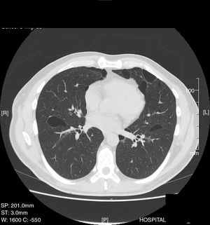 Quistes pulmonares bilaterales.