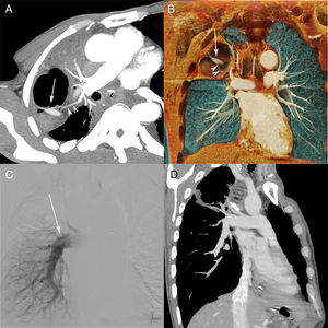 (A) Computed tomography (CT) pulmonary angiography (reconstruction with maximum intensity projection) showing a cavitated consolidation in the right upper lobe, with a highly enhancing nodule inside the cavity (arrow). Note also the relationship of the feeding vessel (arrowheads) to the pulmonary artery pseudoaneurysm (PAP; arrow). (B) Three-dimensional coronal reconstruction clearly depicts the PAP (arrow) and feeding vessel (arrowheads). (C) Pulmonary angiography performed 1 week after CT shows oligemia in the right upper lobe, with no opacification of the feeding vessel or PAP. A follow-up CT pulmonary angiography (D) demonstrated complete occlusion of the vessel and PAP, and partial resolution of the cavity.