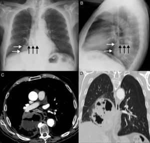 A) Radiografía posteroanterior de tórax en la que se observa una opacidad en hemitórax derecho (flechas blancas) con un nivel hidroaéreo (flechas negras) en su interior. Nótese la presencia del fundus gástrico (asterisco) en el espacio subfrénico izquierdo. B) Radiografía lateral de tórax en la que se confirma la localización retrocardíaca de la opacidad (flechas blancas) con el nivel hidroaéreo (flechas negras). C) Imagen axial de la TC en la que se identifica una masa extensamente necrótica y cavitada (asterisco) en región paramediastínica del lóbulo inferior derecho. Nótese la presencia de un nivel hidroaéreo en el interior de la cavitación. D) Imagen coronal de la TC (ventana de parénquima pulmonar) en la que se confirma la naturaleza intrapulmonar de la lesión y la integridad de ambos hemidiafragmas.