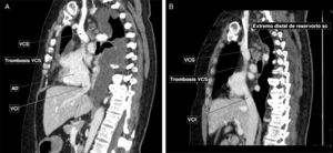 A) Tomografía computarizada con contraste intravenoso en fase venosa. Corte sagital. Se identifica un defecto de repleción de vena cava superior, proximal a la desembocadura del cayado de la ácigos, hasta la entrada en la aurícula derecha. Compatible con trombosis al menos parcial de dicha estructura. Asocia importante derrame pleural. B) Corte sagital. Extremo distal de reservorio subcutáneo, en relación con trombosis de vena cava superior.