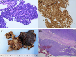 A) Biopsia con aguja gruesa de la masa pulmonar: anatomía patológica microscópica de la muestra, estableciéndose un diagnóstico de carcinoma microcítico por la presencia de células de pequeño tamaño con núcleo hipercromático oval o fusiforme finamente granular, con nucléolo poco llamativo, membrana nuclear fina, citoplasma escaso y poco teñido, estroma escaso y vascular (A1), e inmunohistoquímica positiva para CD56 (A2). B) Muestra intraoperatoria (lobectomía inferior derecha y pleurectomía parietal): anatomía patológica macroscópica (B1); visión panorámica de la anatomía patológica microscópica de la muestra intraoperatoria, objetivándose un tumor limitado a la pleura sin afectación del parénquima pulmonar (B2).