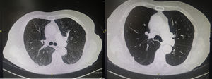 Left image: Chest CT scan showing diffuse bilateral areas of ground-glass opacity without architectural distortion, lymphadenopathy, or other abnormalities. Right image: Resolution of radiographic abnormalities after 3 months of withdrawal of MTX treatment.