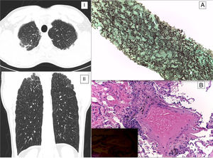 (I) Axial and coronal (II) HRCT image show pleural and sub pleural thickening with mild fibrotic changes in the marginal parenchyma with apical-caudal distribution. (A) Preservation of the alveolar architecture; marked elastosis in the alveolar septa and obliteration of airspaces by fibrosis (EVG, 100×) – suggestive of pleuropulmonary fibroelastosis. (B) Small aggregates of histiocytes and anthracose pigment around bronchioles (H&E; 200×); birefringent silicate crystals are identified using polarized light (inset) – suggestive of early silico-anthracosis.