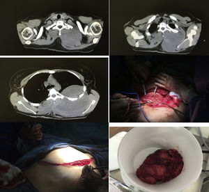 Imagen TAC de un tumor desmoide gigante de pared torácica con crecimiento extra e intratorácico e imagen de la resección quirúrgica.