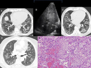 A. Caso 1: corte axial de TACAR torácica (ventana pulmonar). Se muestra una afectación intersticial reticular, con engrosamientos septales y opacidades en vidrio deslustrado en las bases pulmonares y bronquiectasias por tracción (flecha). B. Caso 1: en la ecocardiografía con contraste mediante la inyección con suero salino agitado se observa el paso tardío de las burbujas en la aurícula izquierda luego de 3 a 6 latidos (flecha). AD: aurícula derecha; AI: aurícula izquierda; VI: ventrículo izquierdo. C. Caso 2: corte axial de TACAR torácica (ventana pulmonar). Presencia de una reticulación subpleural con gradiente apicobasal, que se acompaña de distorsión de la arquitectura pulmonar y bronquiectasias por tracción. También se aprecian áreas de vidrio deslustrado con engrosamientos septales. D. Caso 3: corte axial de TACAR torácica (ventana pulmonar) en el que se observan opacidades pulmonares en vidrio deslustrado bilaterales, parcheadas. E. Caso 3. Imagen histológica en la que se evidencian focos de hemorragia con escasos cambios reactivos del epitelio alveolar. También se observa inflamación e hiperplasia neumocitaria que alternan con áreas de fibrosis laxa que sustituye el parénquima pulmonar. Estos hallazgos son compatibles con daño alveolar agudo (tinción hematoxilina-eosina, ×100).