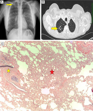 Siliconoma pulmonar. A) Radiografía de tórax, proyección PA, se visualiza lesión cavitada en LSD superpuesta a clavícula y arco de segunda costilla. B) Corte axial de TC torácica donde se visualiza lesión cavitada de 15×16mm en LSD. C) muestra histológica de biopsia pulmonar quirúrgica, tinción hematoxilina-eosina ×40. Infiltrado linfohistiocitario con células gigantes multinucleadas (estrella roja). Cuerpo extraño, restos de polímeros de silicona (estrella amarilla).