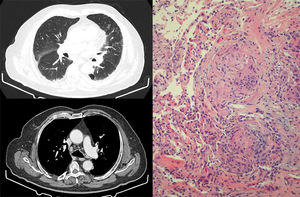 Izquierda: cortes de TACAR torácica que muestran engrosamiento septal, con nodulillos de predominio subpleural y alrededor de cisuras. En mediastino, presencia de adenopatías hiliares y mediastínicas de hasta 15mm. Derecha: muestra de biopsia transbronquial con presencia de granulomas epitelioides no caseificantes. Se identifican células gigantes multinucleadas que se agrupan formando granulomas con escasa celularidad linfocítica acompañante. No se identifica necrosis.