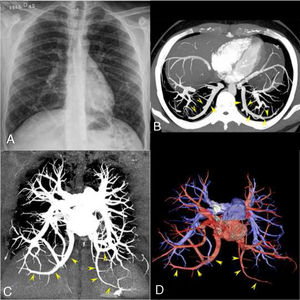 Posteroanterior chest radiograph (A) showing bilateral anomalous curvilinear vessels in the lower pulmonary regions. Enhanced chest computed tomography (CT) examination with axial (B) and coronal (C) maximum intensity projection imaging, which demonstrated bilateral pulmonary veins with anomalous routes in the lower pulmonary regions (yellow arrowheads), but draining normally into the left atrium. Coronal volume-rendering 3D reconstruction (D) shows the anomalous veins (red) and normal pulmonary arteries (blue).