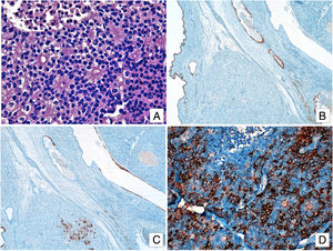 (A) Solid islets and cell clusters separated by a fibrous stroma. Cells display eosinophilic cytoplasm, rounded nuclei and fine granular chromatin. Metastatic lesion: Mature glandular tissue staining positive for CDX2 (B) and CK7 (C). (D) Tumor cells staining positive for chromogranin-A.