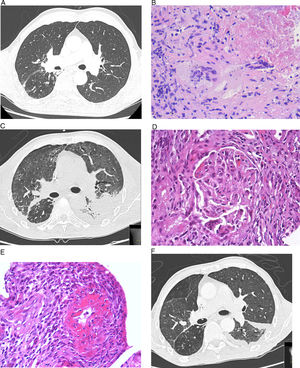 A. Tomografía computarizada (TC) de tórax de alta resolución. No hay evidencia de enfermedad ni derrame pleural en campos medios e inferiores. B. Biopsia pulmonar. Inflamación granulomatosa con extensas áreas de necrosis y células gigantes multinucleadas tipo Langhans. C. TC de tórax de alta resolución. Aumento difuso de la radiodensidad pulmonar con predominio de vidrio deslustrado con moderado derrame pleural izquierdo loculado, con un componente cisural, que se interpretó como una hemorragia alveolar difusa. D. Biopsia renal. Glomérulo renal con área de necrosis focal con fenómenos de cariorrexis. E. Biopsia renal con necrosis fibrinoide de arteria de pequeño calibre que afecta a más del 50% de la circunferencia y que se acompaña de inflamación transmural. F. TC de tórax de alta resolución. Disminución del derrame pleural y ligera mejoría de la opacidad en vidrio deslustrado.