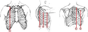 Predefined anatomic lines (1—linea mid-clavicularis, 2—linea axillaris anterior, 3—linea axillaris media, 4—linea axillaris posterior, 5—linea scapularis, 6—linea para vertebralis).