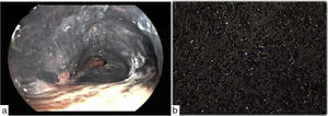 (a) Flexible bronchoscopy shows extensive dark airway pigmentation with bronchial obliteration of both upper lobes. (b) Bronchial mucosa biopsy demonstrates silica crystalline material under polarized light (40×).