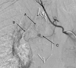 Arteriografía pulmonar: A) Sutura bronquial. B) Sutura de la cisura. C) Pseudoaneurisma de la primera rama de la arteria bronquial.