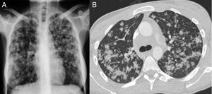 Radiografía de tórax posteroanterior (A) con opacidades pseudonodulares parcheadas que predominan en los campos medios y superiores. No se aprecia derrame pleural ni ensanchamiento mediastínico. TC de tórax en corte transversal (B) en la que se observan opacidades pulmonares centrolobulillares con tendencia a la coalescencia, de predominio en los campos superiores y medios.