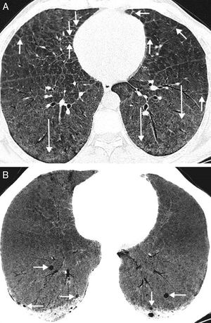 A) Imagen axial de la TC de tórax (ventana de parénquima pulmonar) en la que se observa un engrosamiento de septos interlobulillares (flechas cortas) y áreas de atenuación en vidrio deslustrado (flechas largas). B) Imagen axial de proyección de intensidad mínima (MinIP) de la TC de tórax (ventana de parénquima pulmonar) en la que se visualizan quistes pulmonares de pequeño tamaño en los segmentos basales de ambos lóbulos inferiores (flechas).